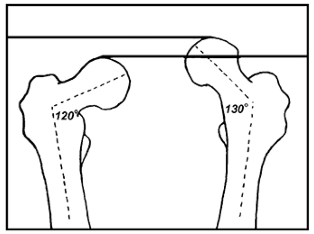 Managing Limb Length Discrepancies Human