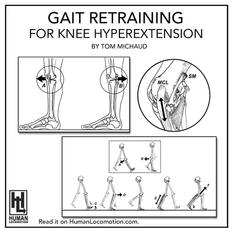Gait Retraining for Knee Hyperextension