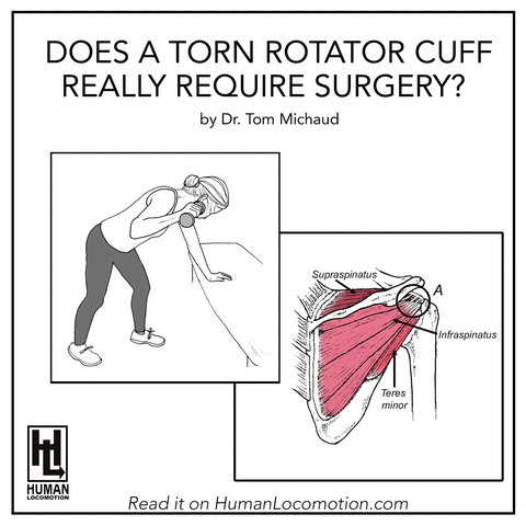 Does a Torn Rotator Cuff Really Require Surgery?