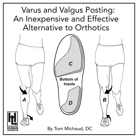 Varus and Valgus Insole Posting: An Inexpensive and Effective Alternative to Orthotics