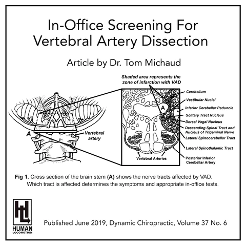 In-Office Screening to Rule Out Vertebral Artery Dissection