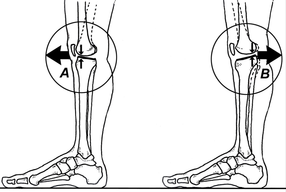 Figure 1. Normally, the tibial plateau tilts back- ward slightly, creating a flexion moment at the knee (A). In some individuals, the tibial plateau is flat or even tilted anteriorly, increasing the likelihood for developing genu recurvatum (B).