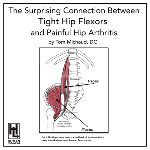 The Surprising Connection Between Tight Hip Flexors and Painful Hip Arthritis