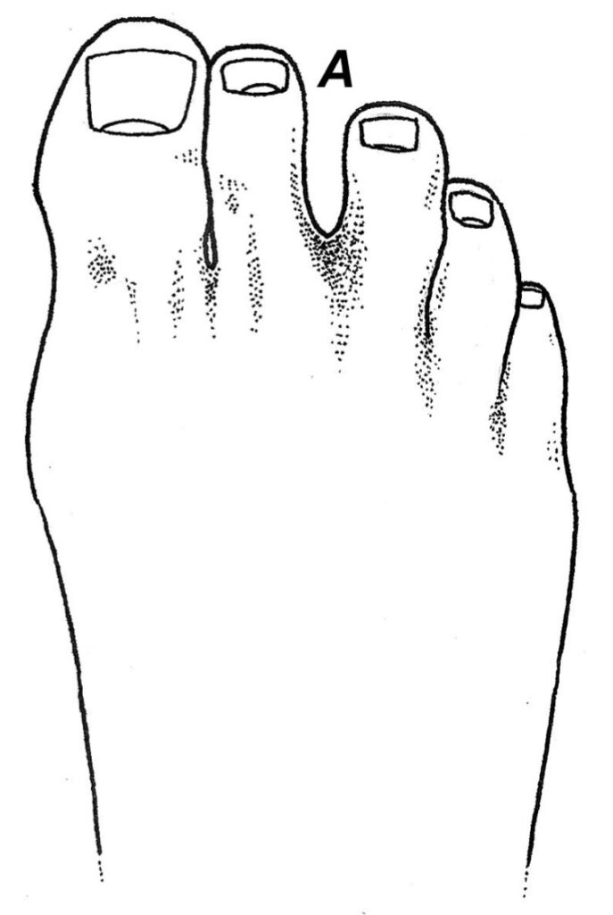 The Peel and Stick Interdigital Neuroma Balance Human