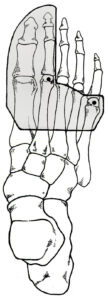 PEEL AND STICK BALANCES: The Interdigital Neuroma Balance - Human ...