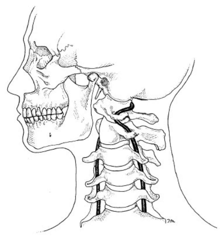 vertebral artery