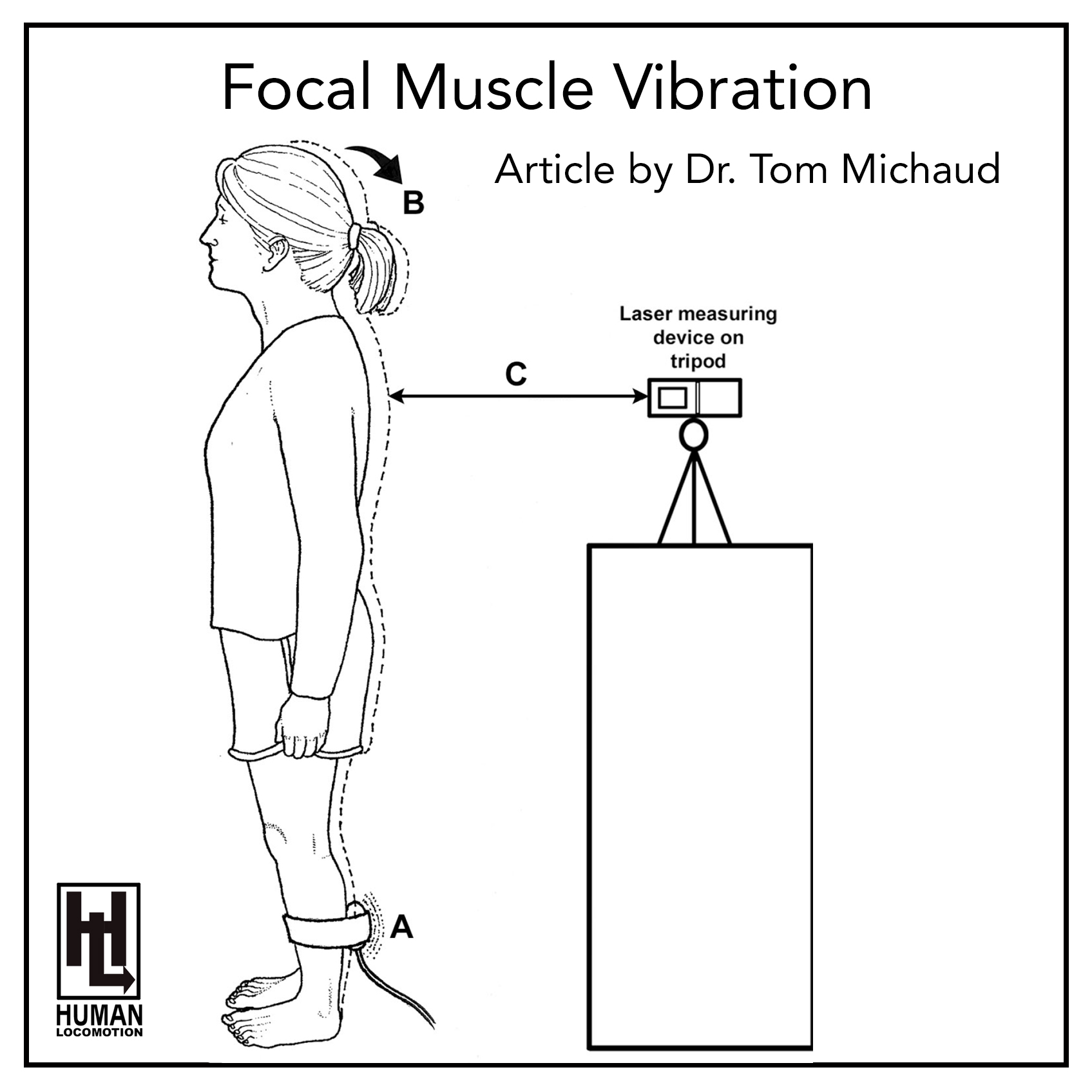Focal Muscle Vibration An Overlooked Tool for Diagnosing and Managing