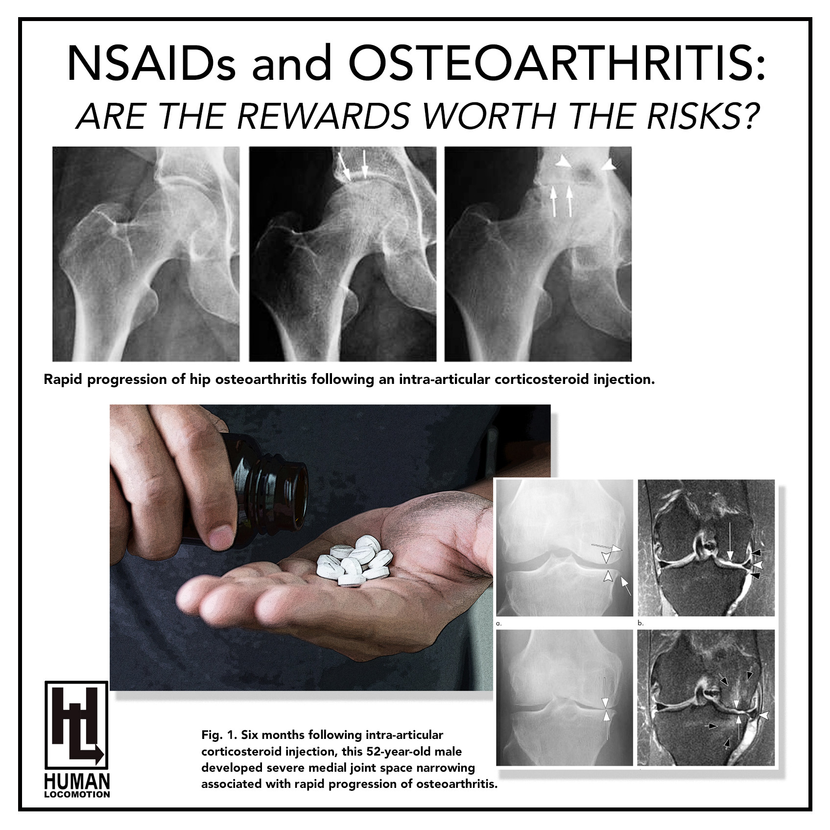 NSAIDS and Osteoarthritis: Are the Rewards Worth the Risks? - Human ...