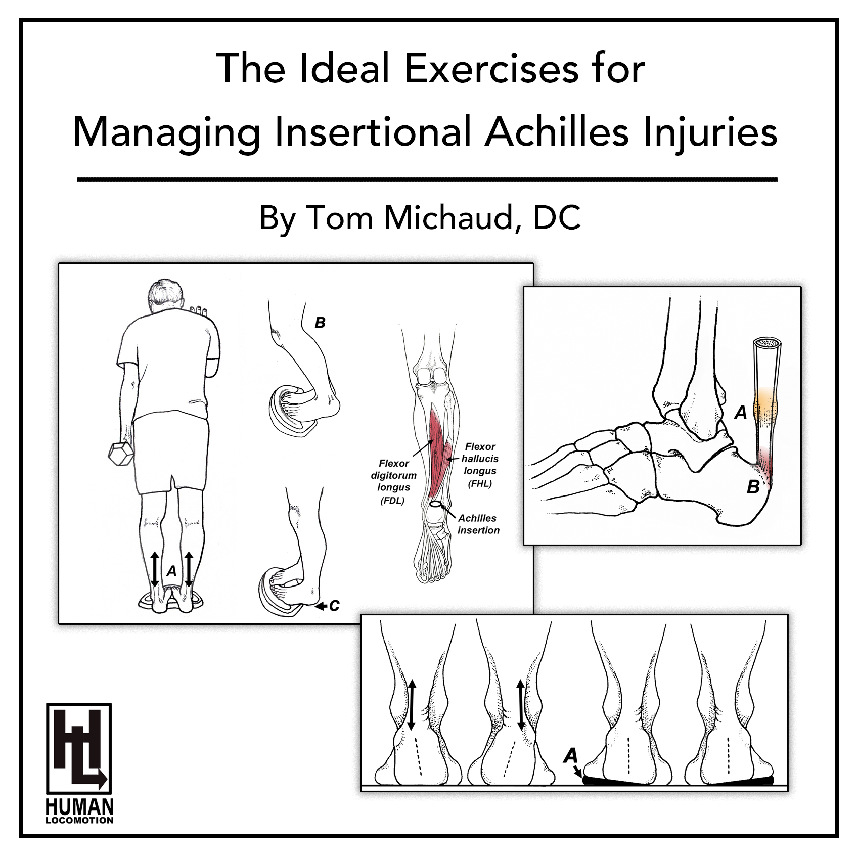 Achilles tendinopathy | Physio Check