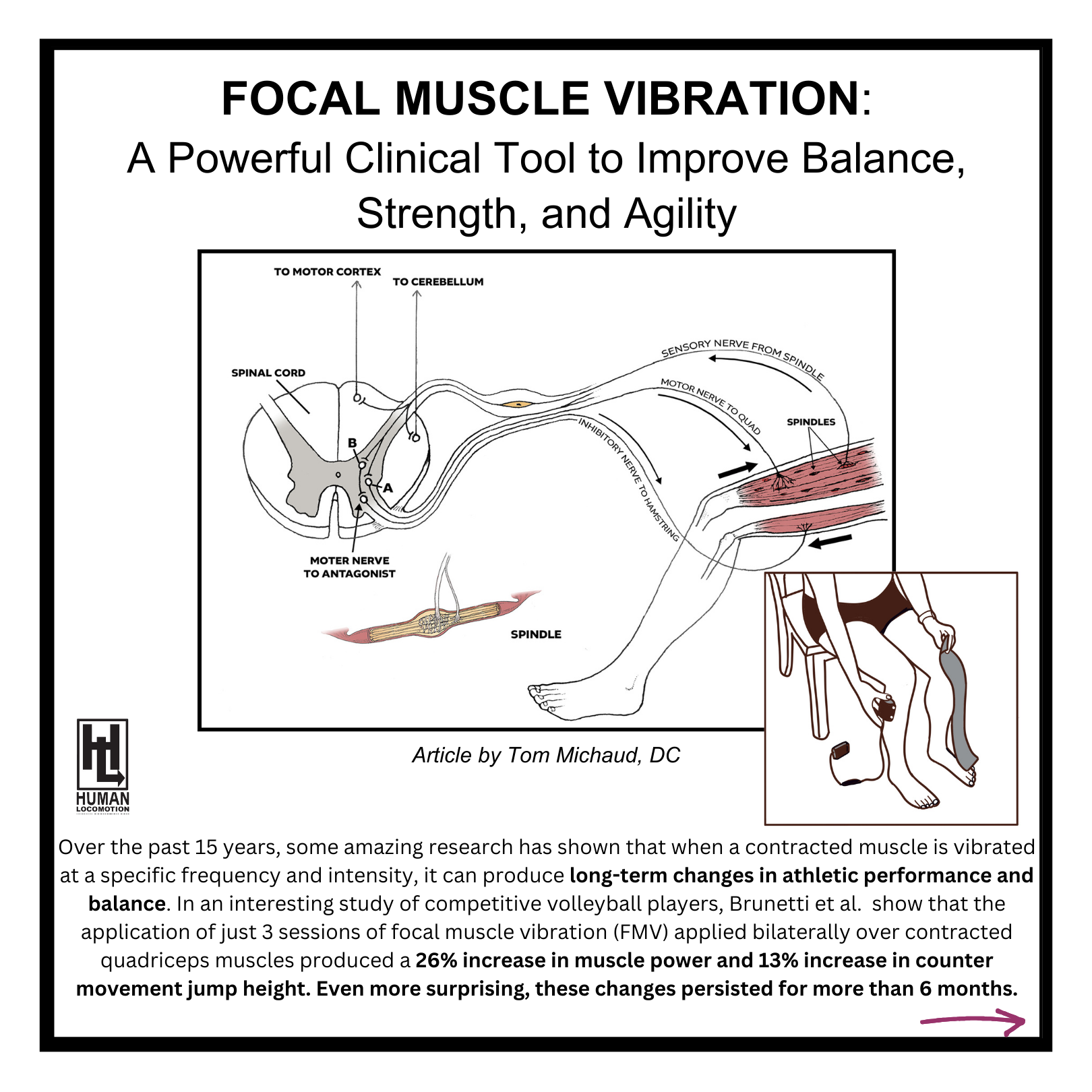 Focal Muscle Vibration: A Powerful Clinical Tool to Improve Balance, Strength, and Agility