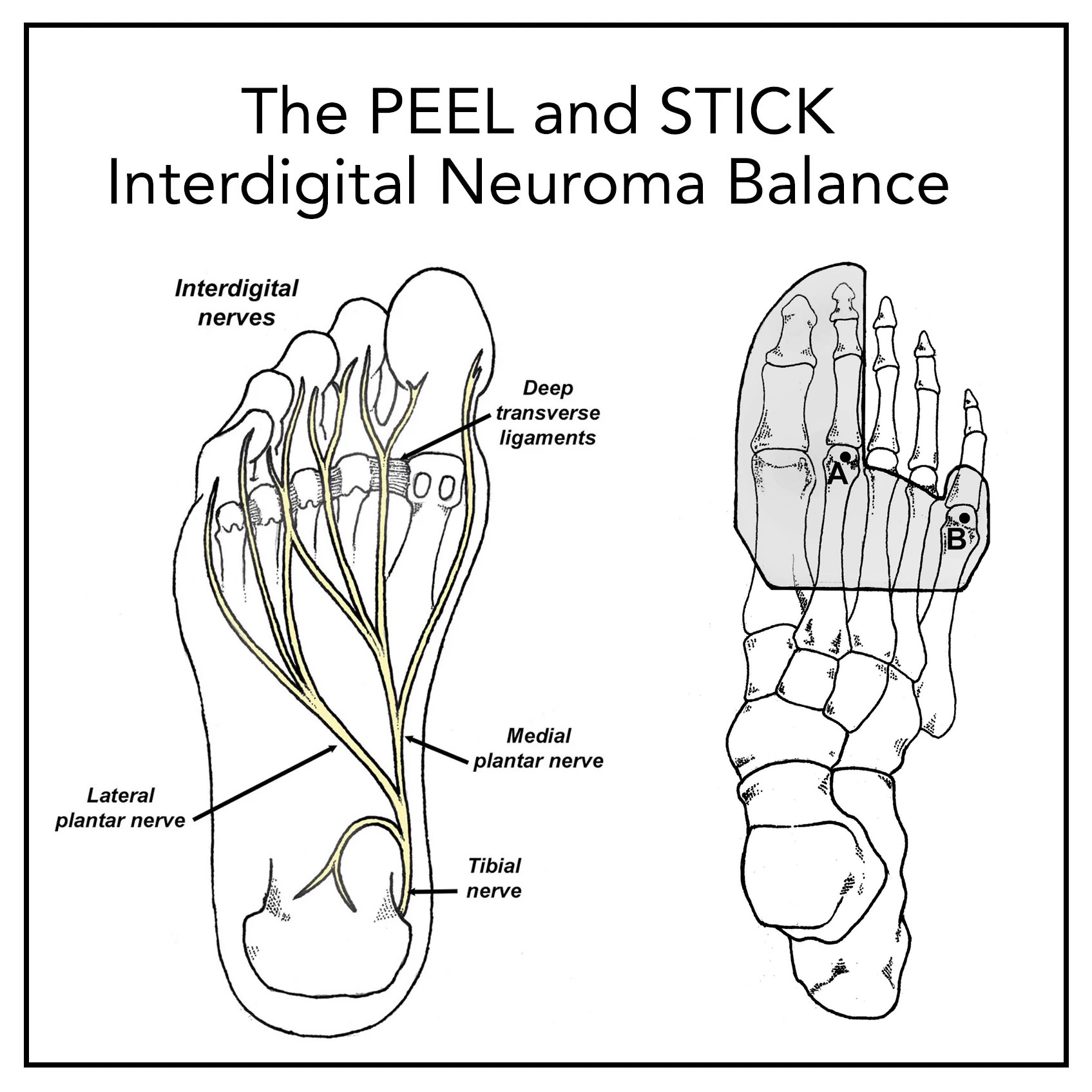 PEEL AND STICK BALANCES: The Interdigital Neuroma Balance - Human ...